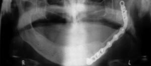 Broken jaw repaired with implant made from fibula. 