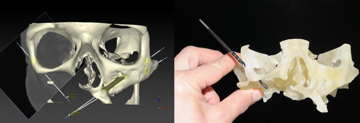 3D versionling surgical manuals and via a 3D printed skull for surgical preplanning.