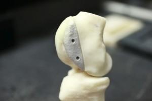 A 3D printed femoral chondyle implant.