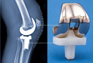 A traditional plastic and metal knee implant.