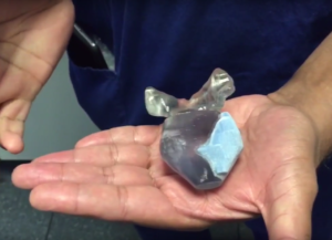 A 3D printed replica of a prostate gland with a cancerous tumor.