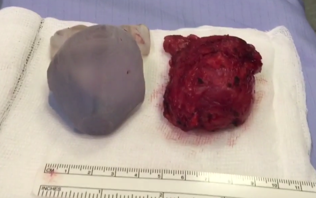 UK Doctors Successfully Remove Tumor with Help From a 3D Printed Prostate Model