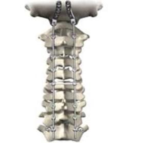 Spinal cade implants.