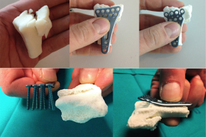 The metal plates are first tested on the 3D printed bone replicas to ensure an ideal fit.