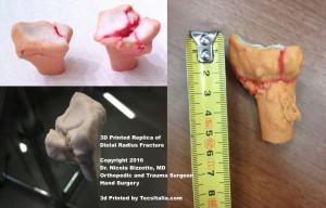 One of the distal radius fractures 3D printed by Dr. Bizzotto's team.
