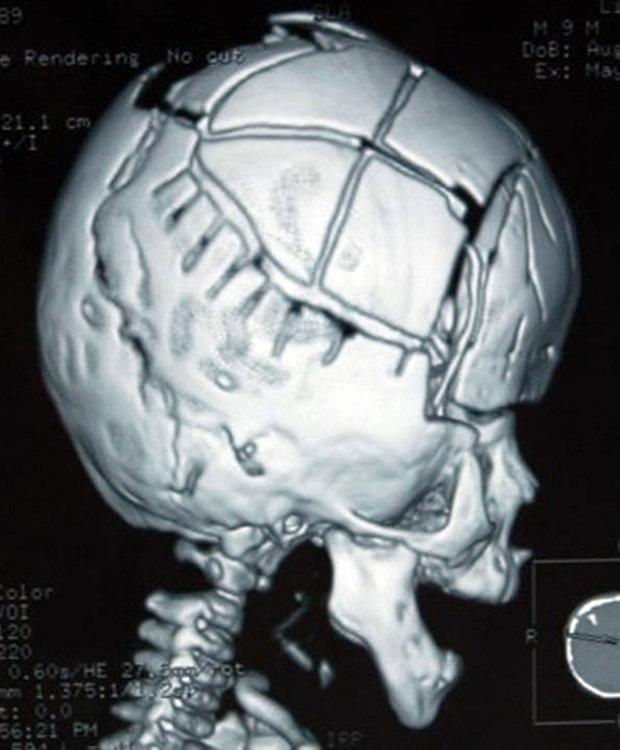 Surgeons were able-bodied to manufacture a 3D printed version of the baby’s skull. [Image: CEN]