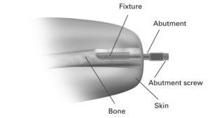 A diagram explaining how the implanted prosthetic works. 
