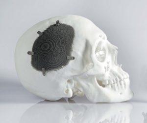 3D printed skull implant. Image: Tobias Hase 