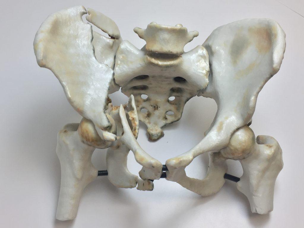 3D printed medical model of a hip trauma.