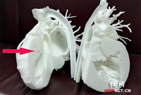 The Second Xiangya Hospital of Central South University in China’s Hunan Province uses a 3D printer to produce a 1:1 replica of a child patient's heart. /Photo via Rednet.cn