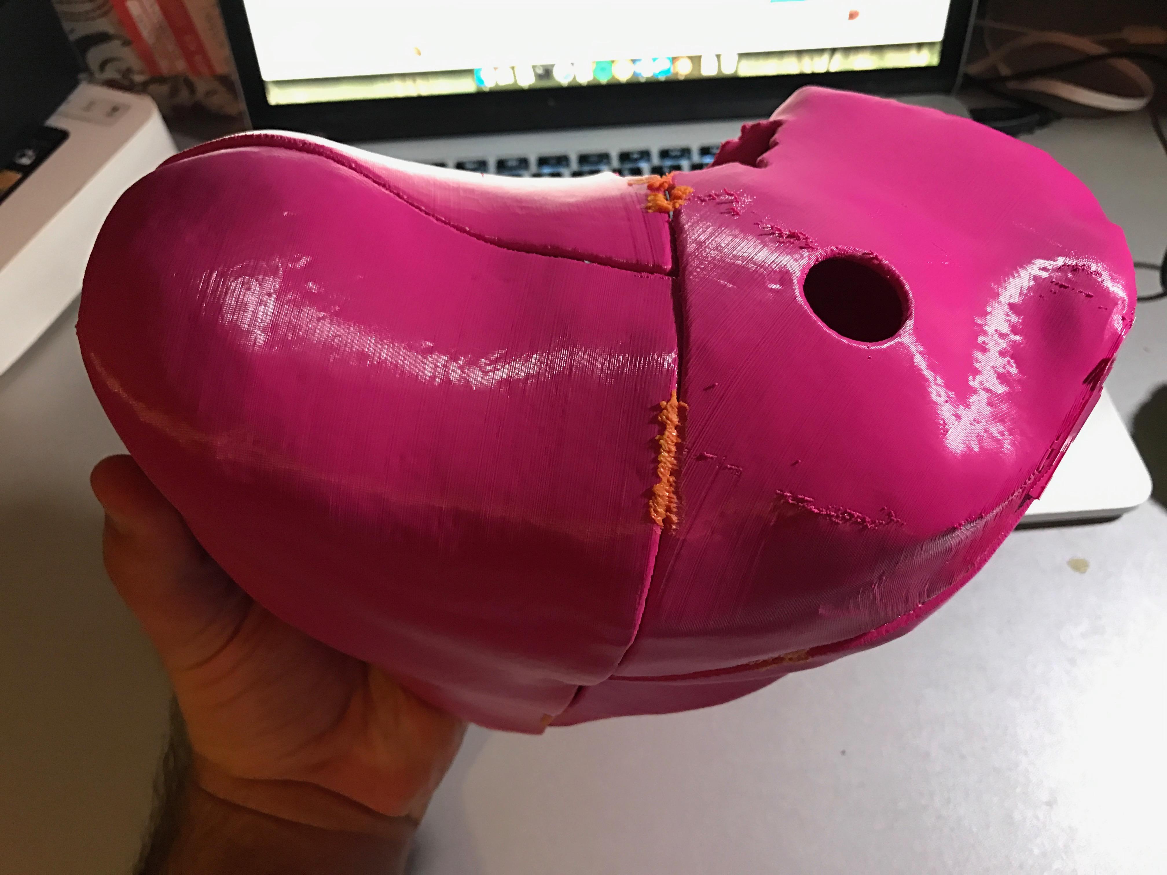 Medical Student Creates Patient-Specific 3D Printed Liver Model for ...