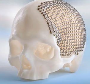 KLS Martin Group Uses LaserCUSING to 3D Print Patient-Specific Craniomaxillofacial Surgical Implants and Systems
