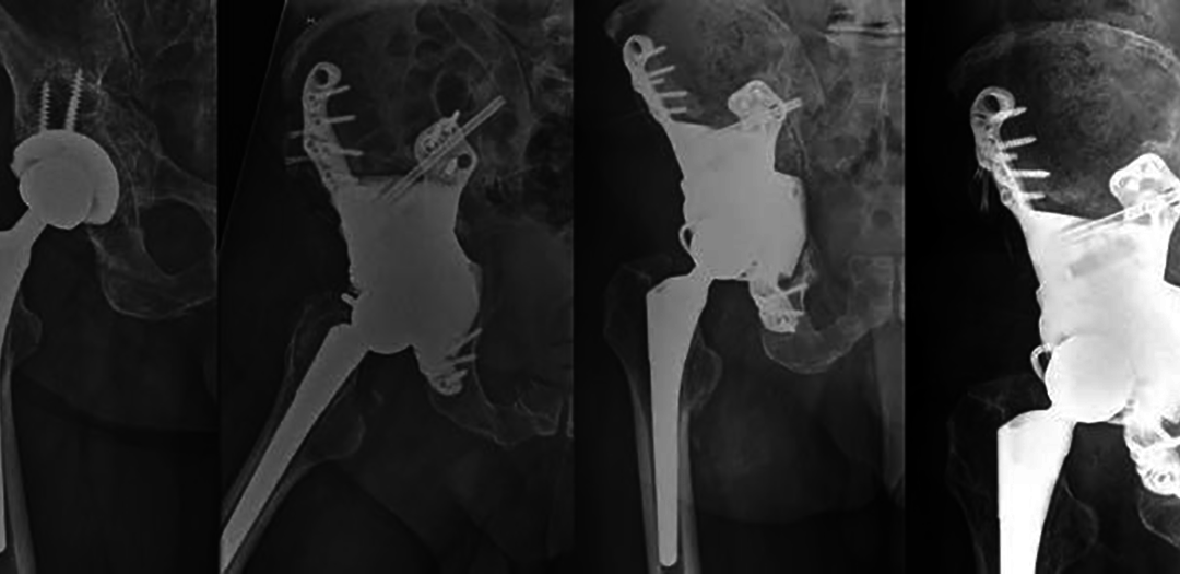 Materialise aMace Technology Leads to 3D Printed Hip Implants for Five New Patients