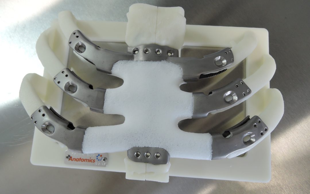 3D Printed Composite Sternum and Rib Cage Implanted for the First Time in the US