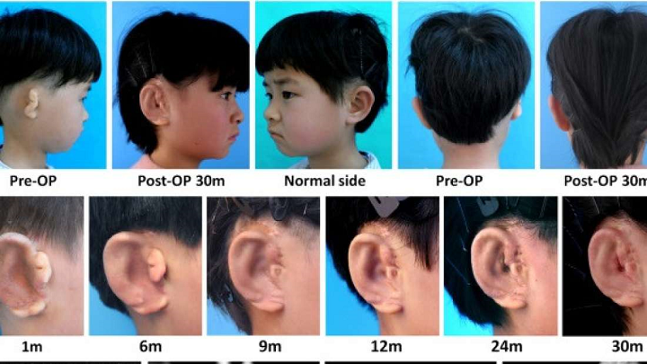 Five Children Receive Ear Implants Made From Their Own Cells, Thanks to 3D Printed Molds and Scaffolds