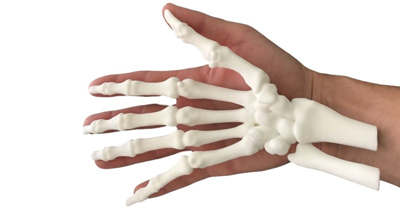 Patient-Specific 3D Printed Models by Stoke Med Allow Surgeons to Offer Better Care