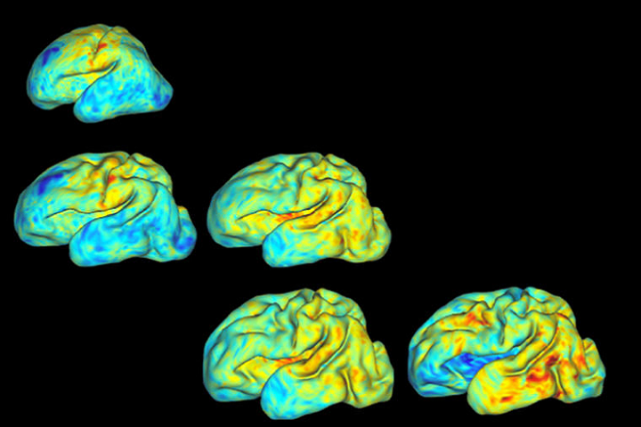 Researchers Use 3D Mapping to Measure Growth and Folding Patterns in Pre-Term Babies' Brains