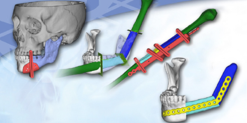 3D Systems and Onkos Surgical Partner to Improve Cancer Patient Outcomes Through 3D Printing and Virtual Surgical Planning