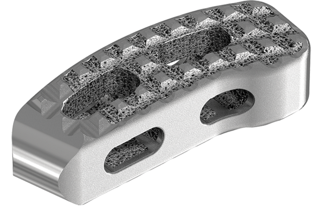 Stryker’s Latest 3D Printed Spinal Implant Receives FDA Clearance