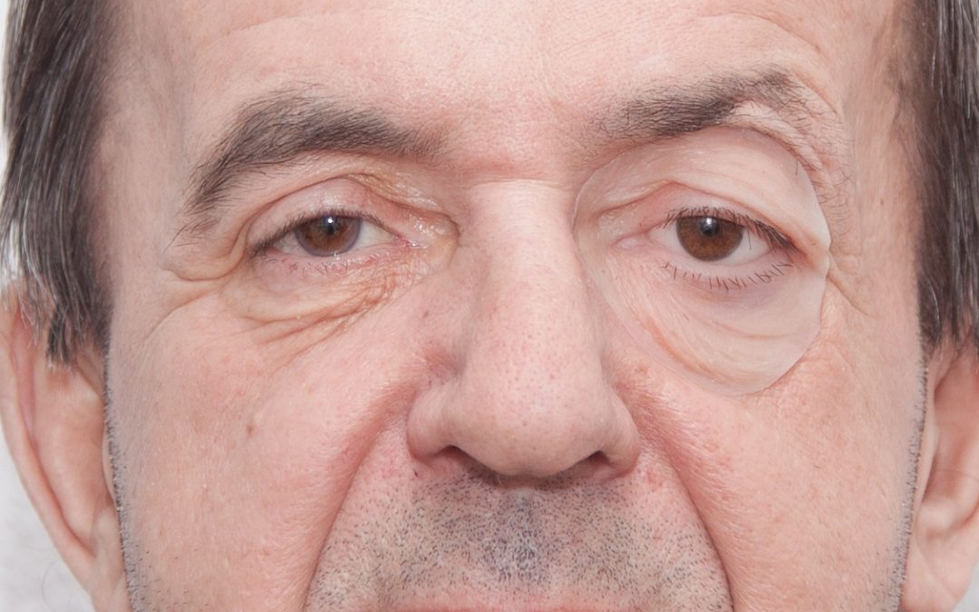 3D Scanning and 3D Printing Allow for Production of Lifelike Facial Prosthetics