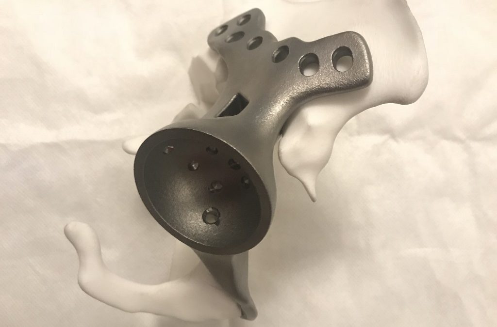 Another First in India: 3D Printed Titanium Implant Helps Man Regain Mobility