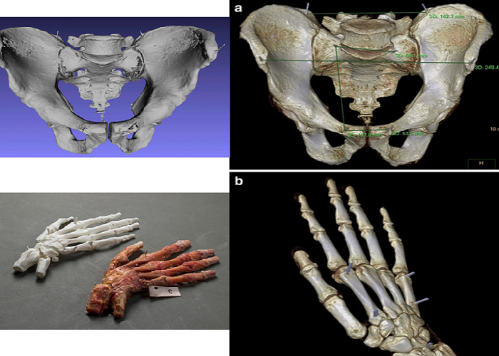 Researchers Compare Human Cadavers and 3D Printed Anatomical Models to Determine Print Accuracy
