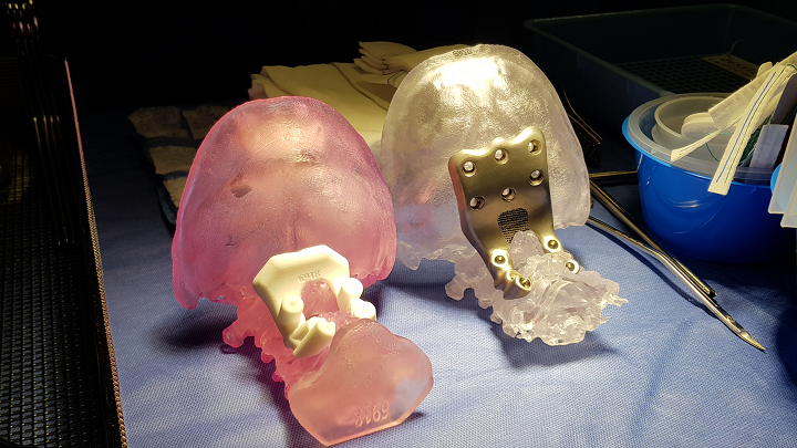 Patient-Specific 3D Printed Spinal Solutions by Anatomics - 3DPrint.com ...