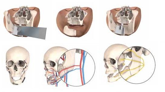 3D Technologies a Vital Component of First Face Transplant Procedure in Belgium