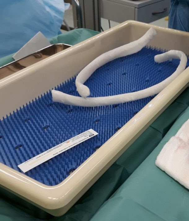 Print On Rib Patient Receives a 3D Printed Rib for the First Time in Bulgaria ...