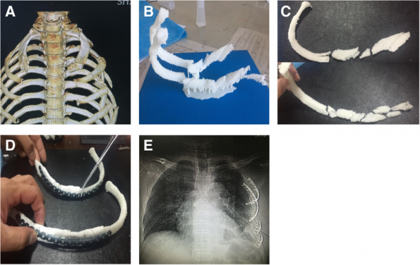 China: Researchers Improve Rib Fracture Surgeries with 3D Printing ...