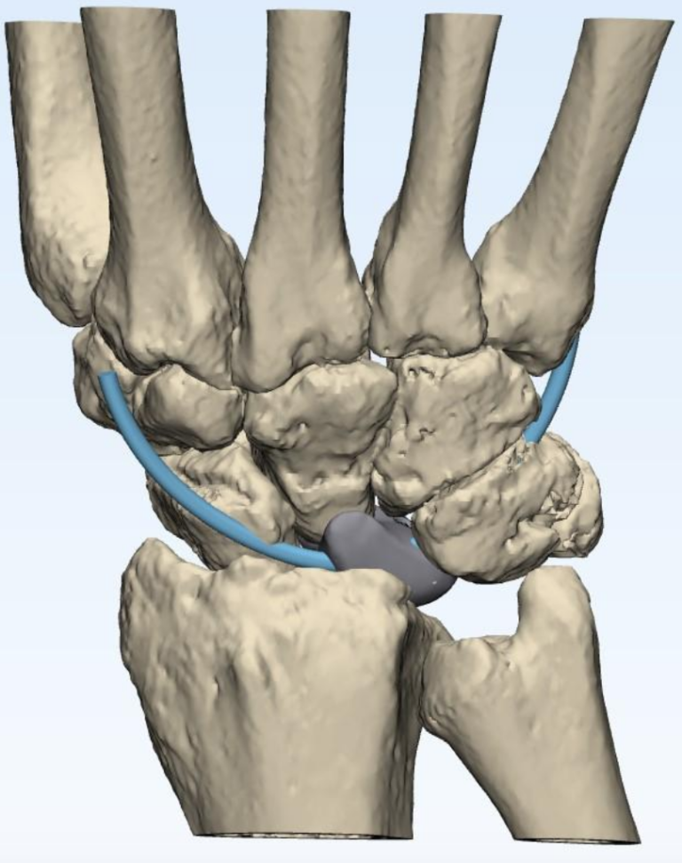 Pioneering 3D Printed Wrist Prosthesis for Kienbock's Disease 3DPrint