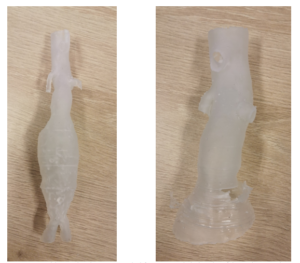 3D Printing Models & Stents for Treatment of Abdominal Aortic Aneurysms ...