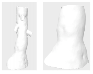 3D Printing Models & Stents for Treatment of Abdominal Aortic Aneurysms ...