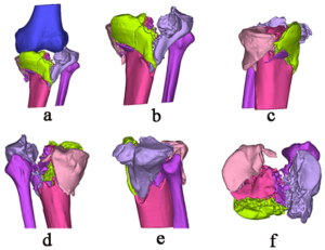 Can A 3D Printed Model Improve The Outcome Of Complex Tibial Plateau ...