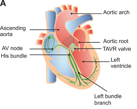 Heart Model with Valves