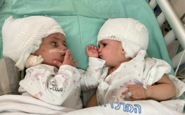 Newly separated conjoined twins in Israel.