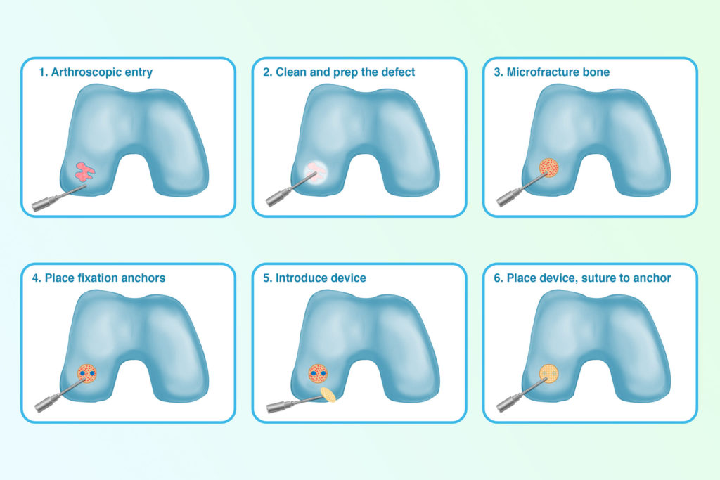 How the Nanochon medical device is used in joints.