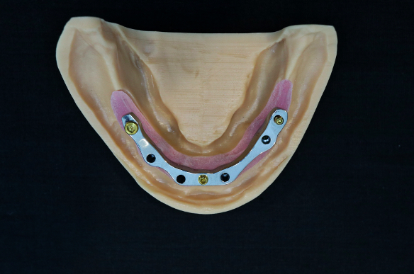 Figure 1.  Patient soft tissue model with implants and milled dental implant bar.