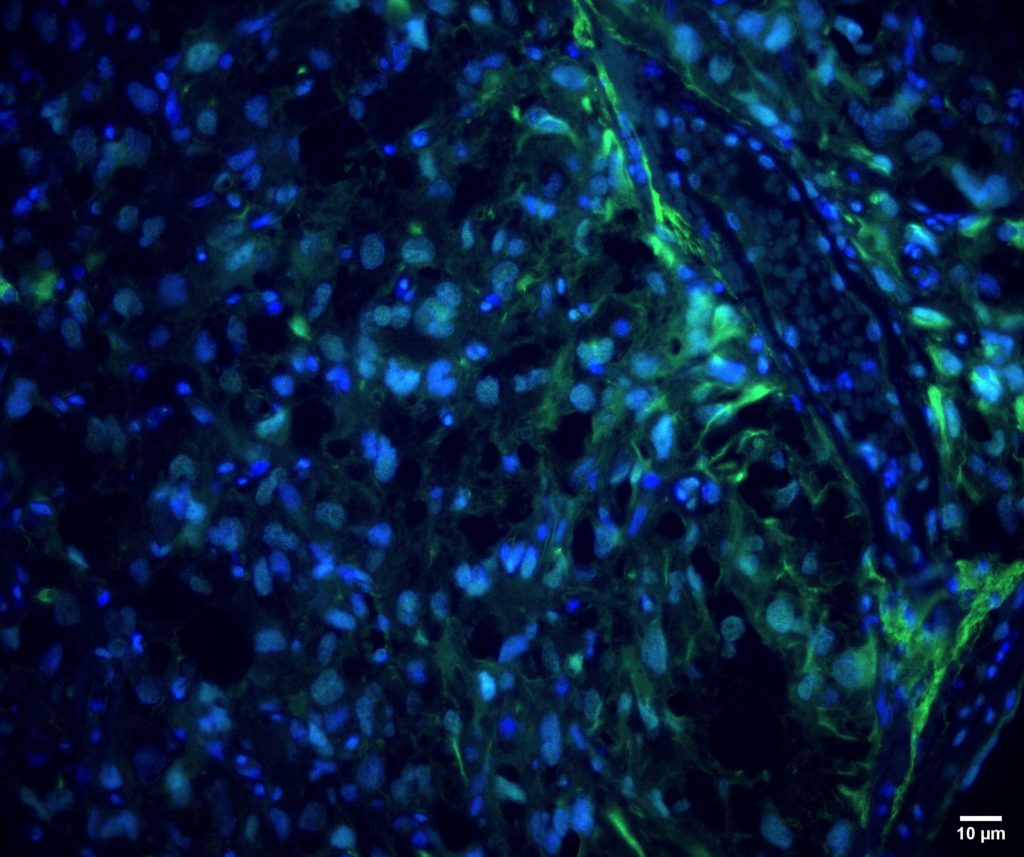 A fluorescent image of one of the brain tumor biopsy.