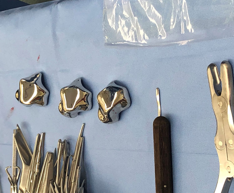 3D printed metallic ankle bone implants
