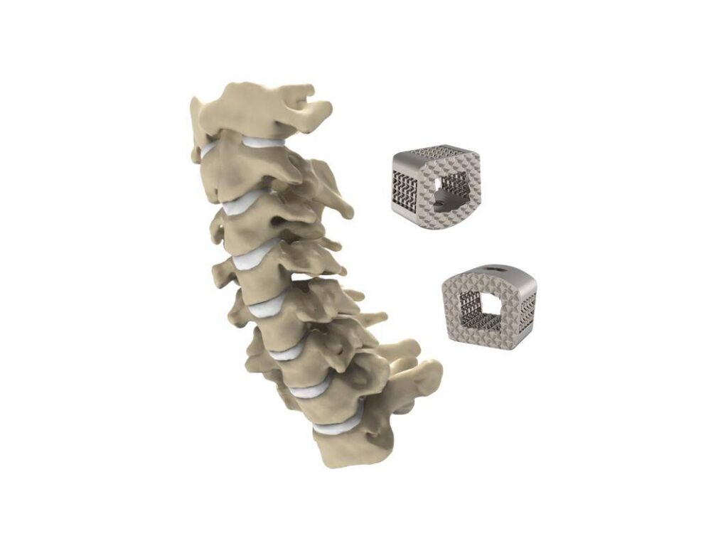 ZSFab Debuts 3D Printed Implants in U.S. Spinal Surgeries - 3DPrint.com ...