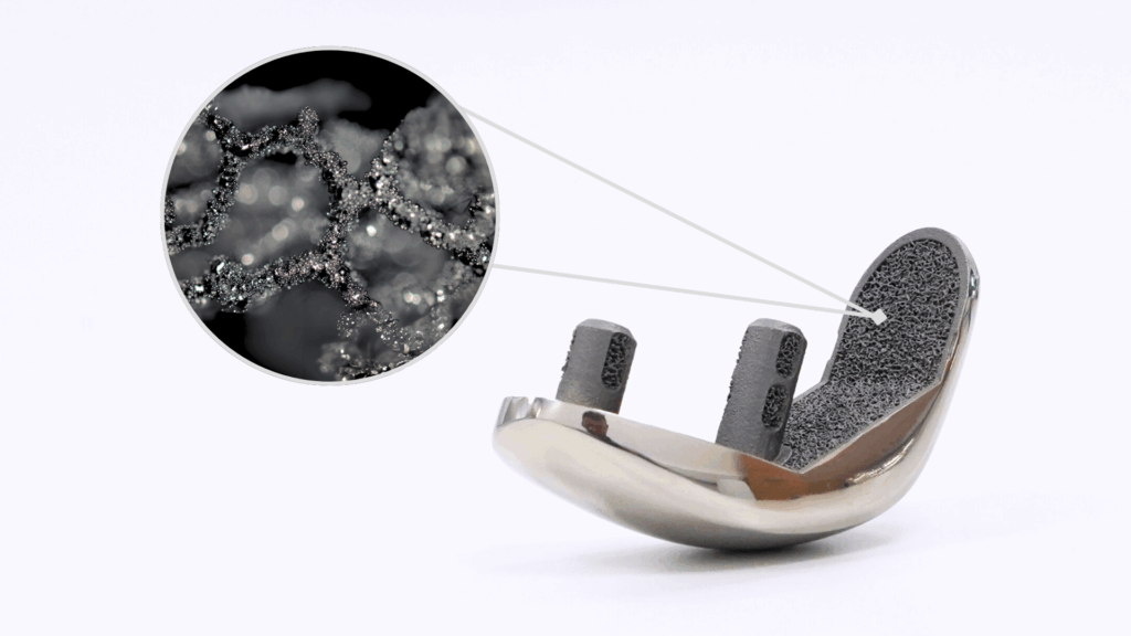 Croom Medical Releases Porous Biofuse Geometry for 3D Printed Lattices3DPrint.com | Additive Manufacturing Business 3 Partial Knee Implant with Biofuse%E2%84%A2 3D Printed Lattice Structure manufactured using Laser Powder Bed Fusion technology in Ti64 Grade 23