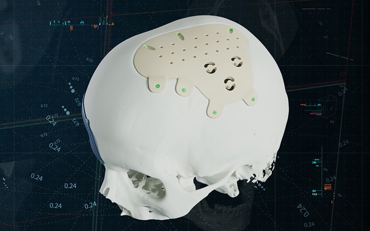 Materialise To Manufacture PEEK CMF Implants